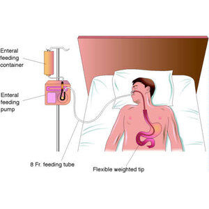 อุปกรณ์ให้อาหารผู้ป่วย/ให้ยา